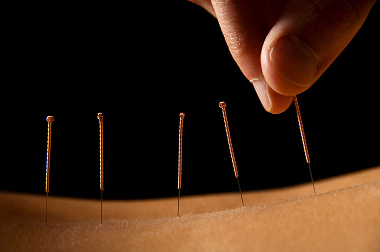 Acupuncture